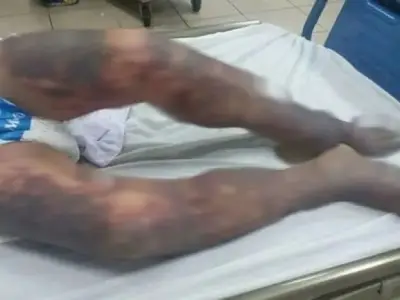 越南一男子食用名菜“黑布丁”　隔天全身发紫，多器官衰竭惨亡