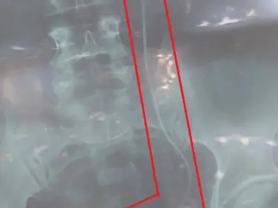越南一医院医生闹乌龙，误将肾结石患者当作腹部异物患者手术