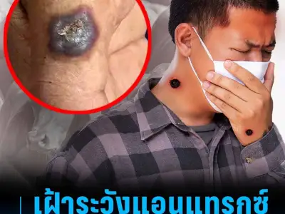 泰东北确认1例炭疽死亡病例！247人高风险！