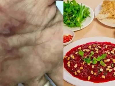 越南女子食生血“果冻”险死，寄生虫皮肤下乱爬，在大脑筑巢