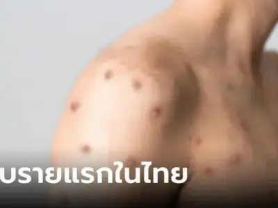 警惕！泰国出现首例猴痘死亡病例，患者同时患有HIV和梅毒